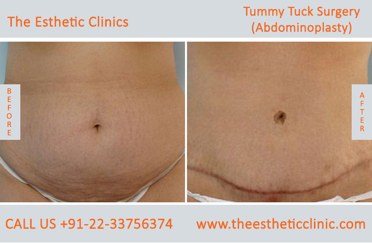 Tummy Tuck Surgery, Abdominoplasty before after photos in mumbai india (2)